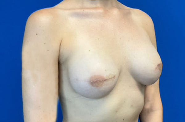 Breast Implant Reconstruction Before & After Gallery - Patient 185278678 - Image 4