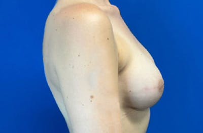 Breast Implant Reconstruction Before & After Gallery - Patient 185278678 - Image 6