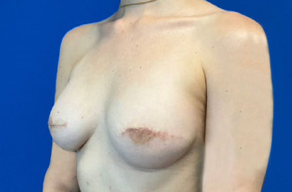 Breast Implant Reconstruction Before & After Gallery - Patient 185278678 - Image 8