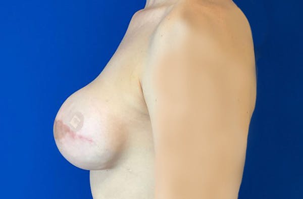 Breast Implant Reconstruction Before & After Gallery - Patient 185278678 - Image 9