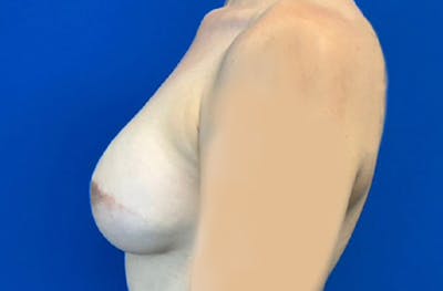 Breast Implant Reconstruction Before & After Gallery - Patient 185278678 - Image 10