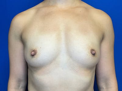 Breast Augmentation Before & After Gallery - Patient 304044 - Image 1