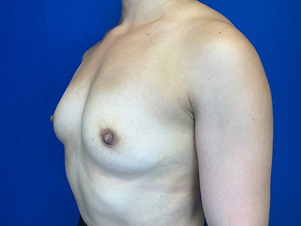 Breast Augmentation Before & After Gallery - Patient 304044 - Image 3