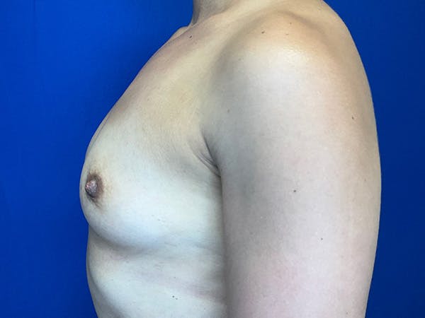 Breast Augmentation Before & After Gallery - Patient 304044 - Image 5