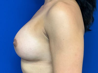 Breast Augmentation Before & After Gallery - Patient 304044 - Image 6