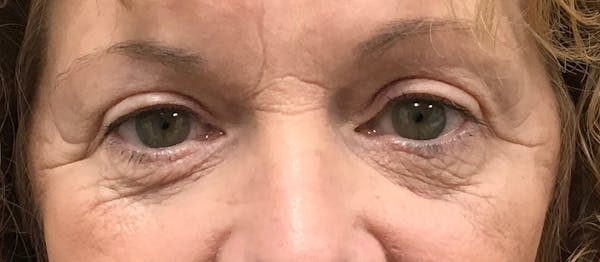 Blepharoplasty Before & After Gallery - Patient 292919 - Image 2
