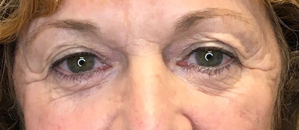 Blepharoplasty Before & After Gallery - Patient 292919 - Image 1