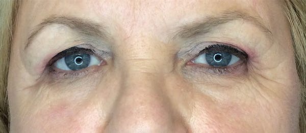 Blepharoplasty Before & After Gallery - Patient 352396 - Image 1