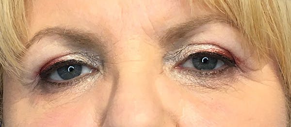 Blepharoplasty Before & After Gallery - Patient 352396 - Image 2