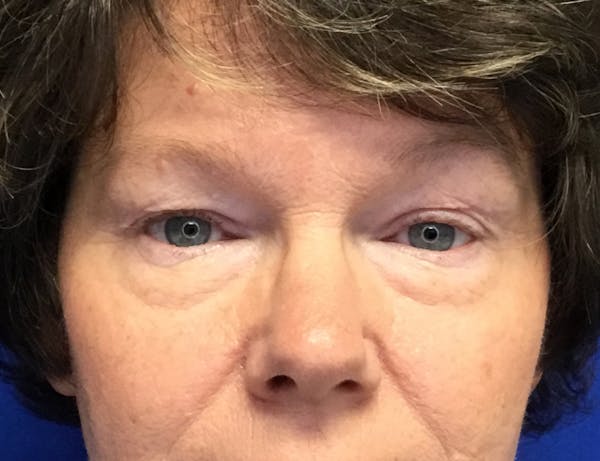 Blepharoplasty Before & After Gallery - Patient 161092 - Image 1