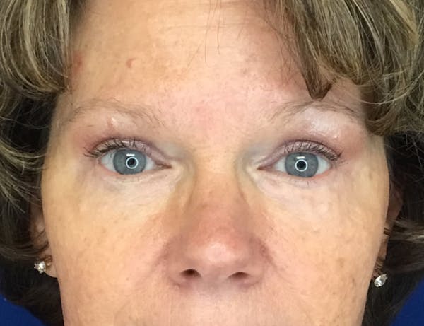 Eyelid Surgery