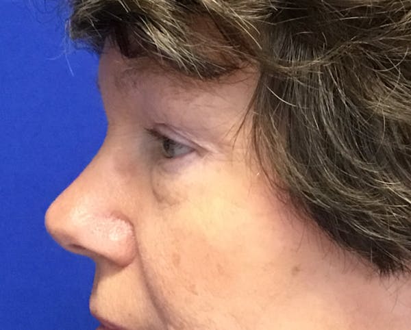 Blepharoplasty Before & After Gallery - Patient 161092 - Image 3