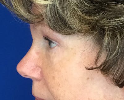 Blepharoplasty Before & After Gallery - Patient 161092 - Image 4