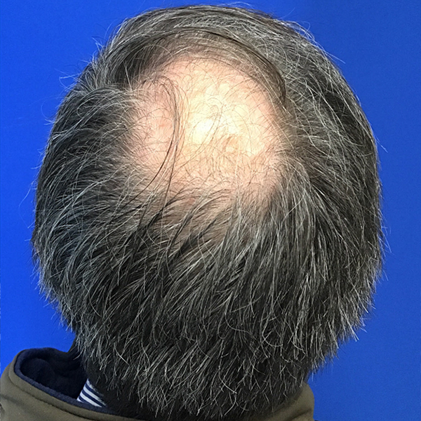 Hair Restoration