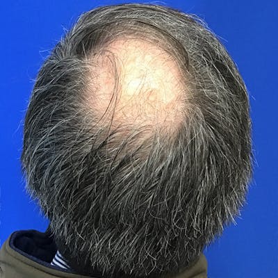 Hair Restoration Before & After Gallery - Patient 769959 - Image 1