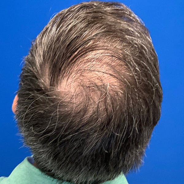 Hair Restoration Before & After Gallery - Patient 769959 - Image 2