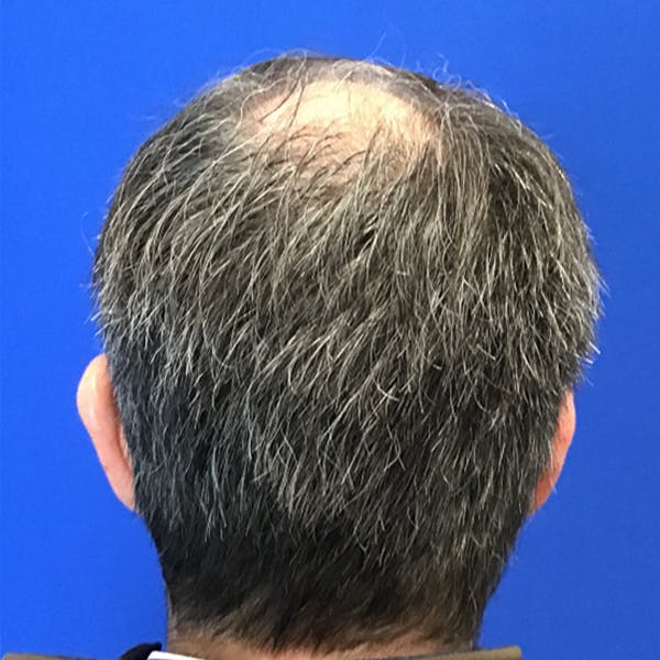 Hair Restoration Before & After Gallery - Patient 769959 - Image 3