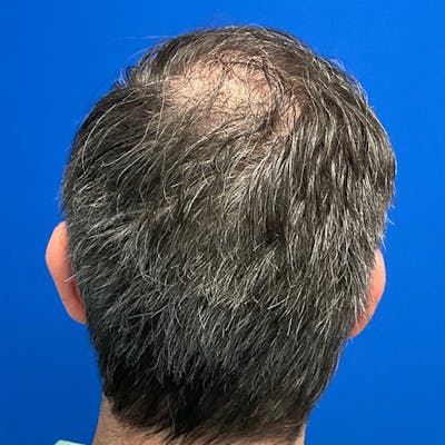 Hair Restoration Before & After Gallery - Patient 769959 - Image 4