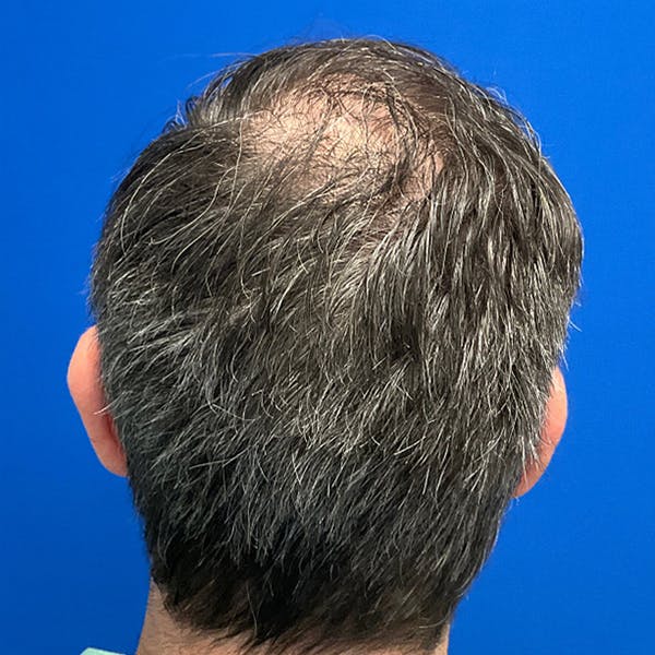 Hair Restoration Before & After Gallery - Patient 769959 - Image 4