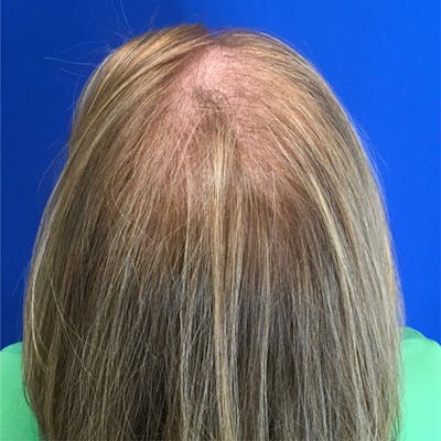 Hair Restoration Before & After Gallery - Patient 196617 - Image 1