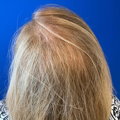 Hair Restoration Before & After Gallery - Patient 196617 - Image 2