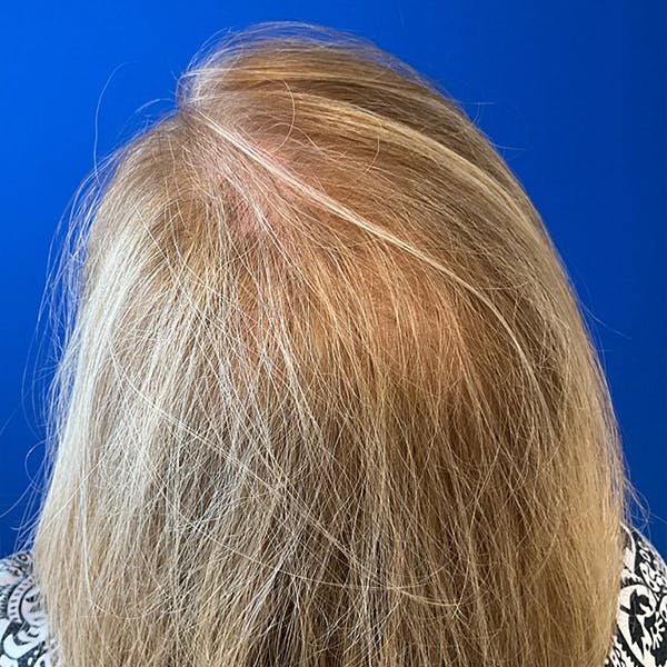Hair Restoration Before & After Gallery - Patient 196617 - Image 2