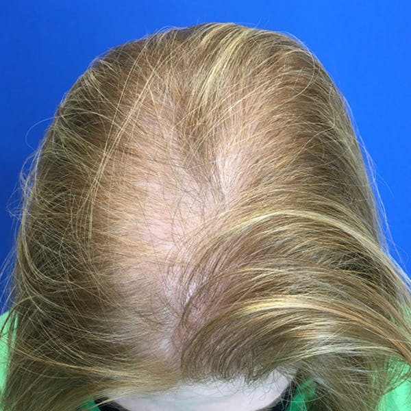 Hair Restoration Before & After Gallery - Patient 196617 - Image 5