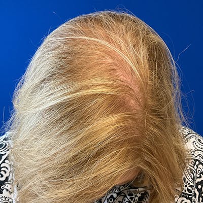 Hair Restoration Before & After Gallery - Patient 196617 - Image 6