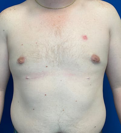 Gynecomastia Before & After Gallery - Patient 340559 - Image 2