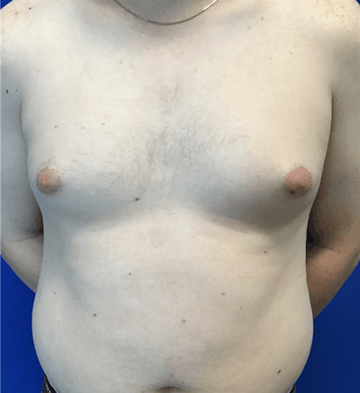 Gynecomastia Before & After Gallery - Patient 340559 - Image 1