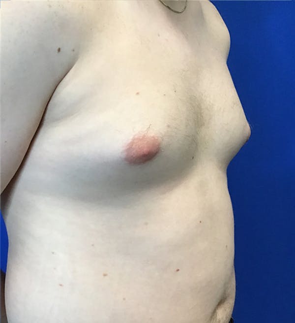Gynecomastia Before & After Gallery - Patient 340559 - Image 3