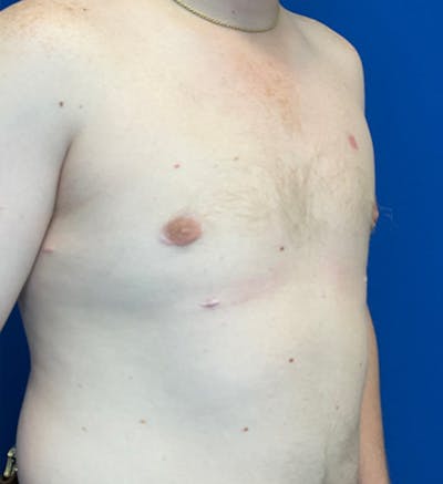 Gynecomastia Before & After Gallery - Patient 340559 - Image 4