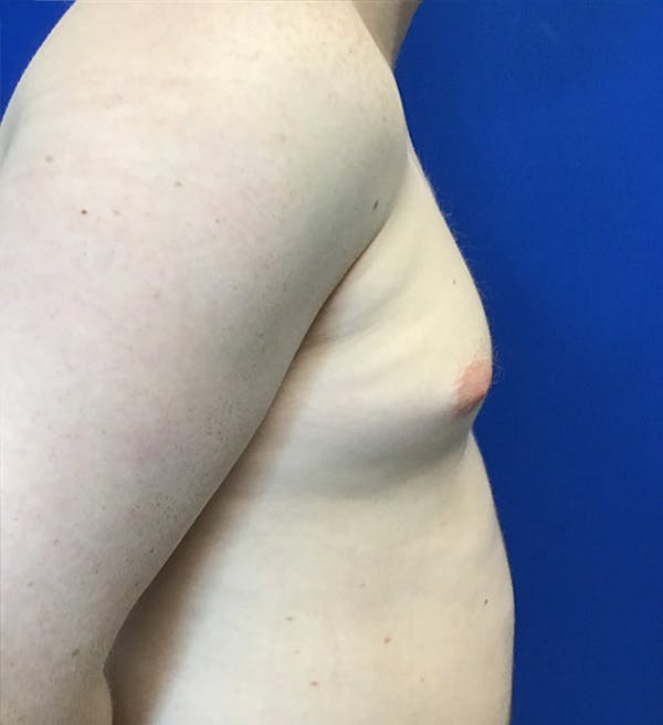 Gynecomastia Before & After Gallery - Patient 340559 - Image 5