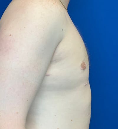 Gynecomastia Before & After Gallery - Patient 340559 - Image 6