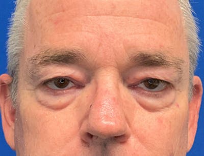 Blepharoplasty Before & After Gallery - Patient 215270 - Image 1