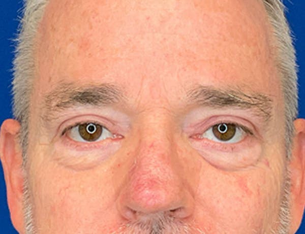 Blepharoplasty Before & After Gallery - Patient 215270 - Image 2