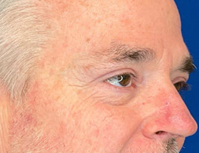 Blepharoplasty Before & After Gallery - Patient 215270 - Image 4