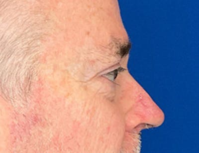 Blepharoplasty Before & After Gallery - Patient 215270 - Image 6
