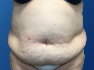 Tummy Tuck (Abdominoplasty) Before & After Gallery - Patient 372636 - Image 1