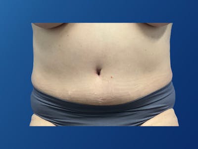 Tummy Tuck (Abdominoplasty) Before & After Gallery - Patient 372636 - Image 2