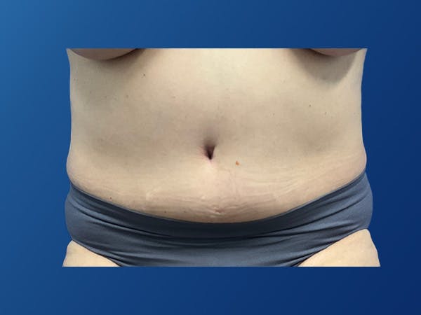Tummy Tuck (Abdominoplasty) Before & After Gallery - Patient 372636 - Image 2
