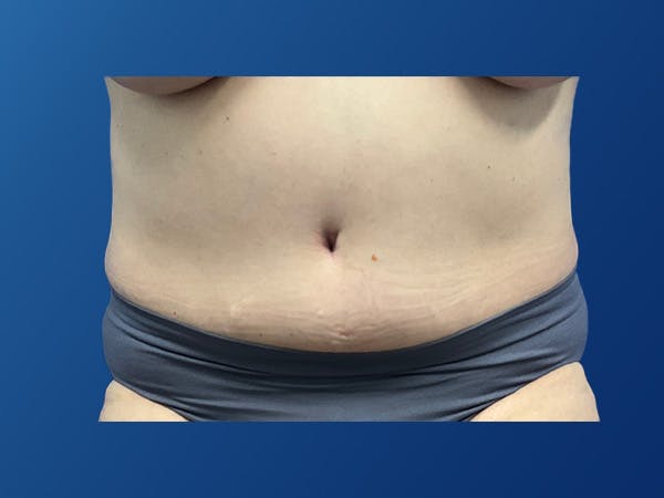 Tummy Tuck (Abdominoplasty) Before & After Gallery - Patient 372636 - Image 2