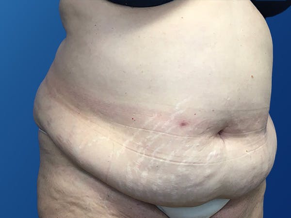 Tummy Tuck (Abdominoplasty) Before & After Gallery - Patient 372636 - Image 3