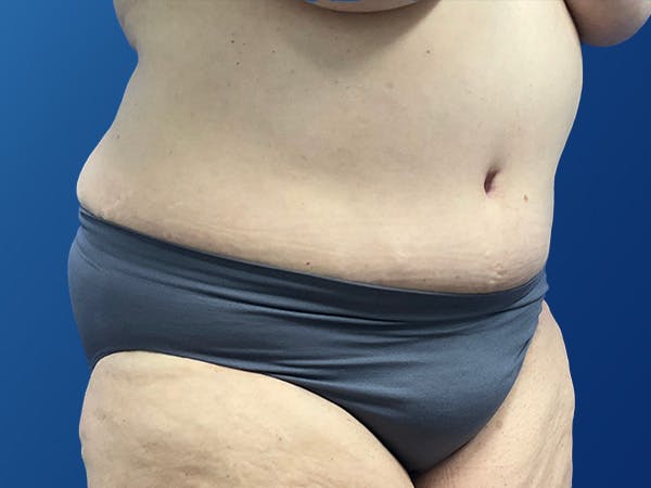 Tummy Tuck (Abdominoplasty) Before & After Gallery - Patient 372636 - Image 4