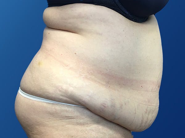 Tummy Tuck (Abdominoplasty) Before & After Gallery - Patient 372636 - Image 5