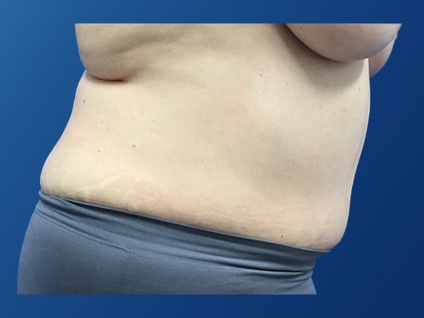 Tummy Tuck (Abdominoplasty) Before & After Gallery - Patient 372636 - Image 6