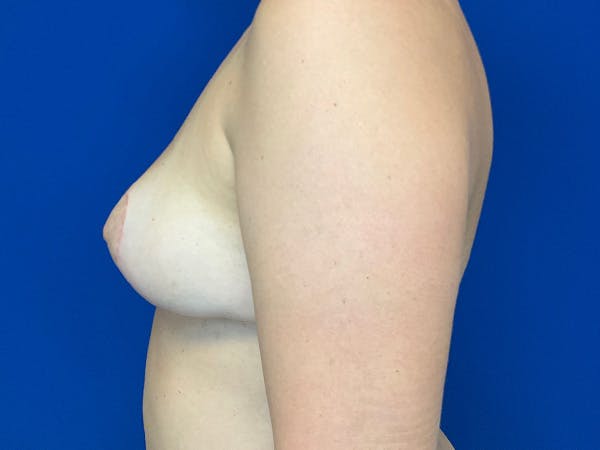 Breast Implant Removal and Replacement Before & After Gallery - Patient 115573 - Image 6