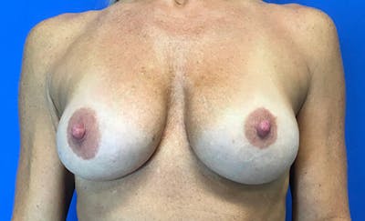 Breast Implant Removal and Replacement Before & After Gallery - Patient 348737 - Image 1