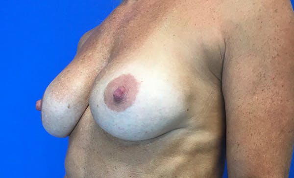 Breast Implant Removal and Replacement Before & After Gallery - Patient 348737 - Image 3
