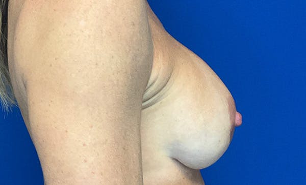 Breast Implant Removal and Replacement Before & After Gallery - Patient 348737 - Image 6